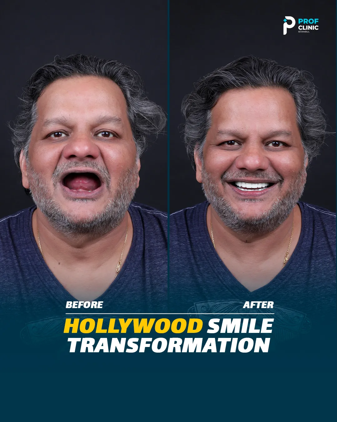 نجاح زراعة الأسنان على 4 غرسات: الأرقام الحقيقية وعمر الغرسة