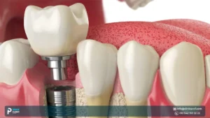Dental Implant Abutment in Turkey: Connecting Implant to Crown