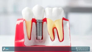 Zimmer Biomet Dental Implants in Turkey: Quality and Planning Guide