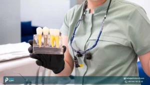 Dental Implant Abutment in Turkey: Connecting Implant to Crown