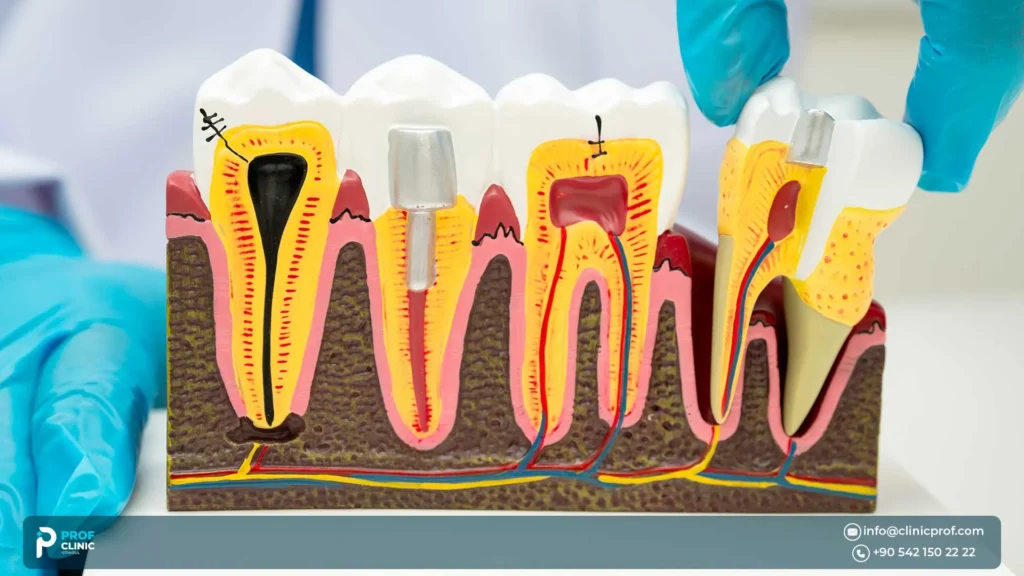 What the Medentika implant process may look like at Prof Clinic in Istanbul