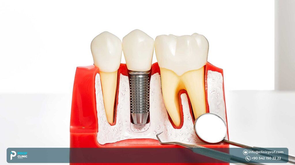Prof Clinic: Best Choice for Dental Implants Abroad