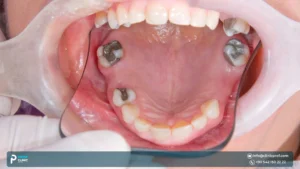 Ridge expansion for dental implants