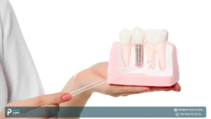 Medentika Dental Implants in Turkey: German Quality, Affordable Value