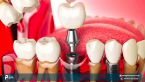 Second Stage Implant Surgery in Istanbul Implant Uncovering and Healing Abutment Guide