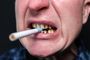 Smoking and Dental Implants in Turkey: Risks, Recovery & Candidacy