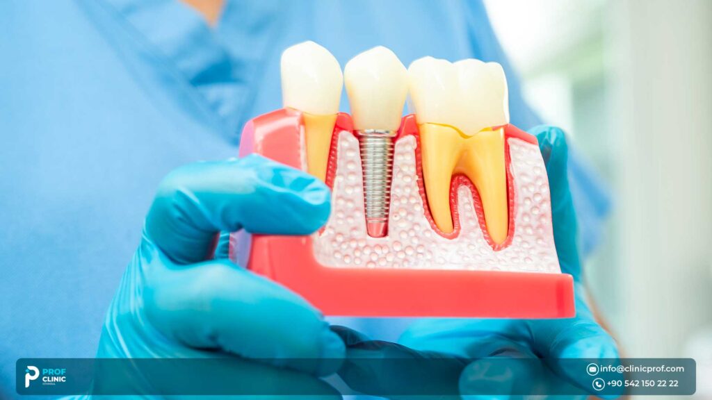 Cheap Dental Implants Abroad Prices