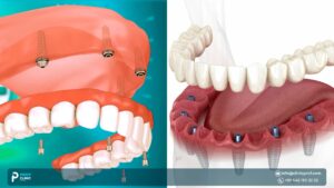 All on 6 Dental Implants Abroad vs All-on-4 in Turkey: Which Is Right for You? 2026