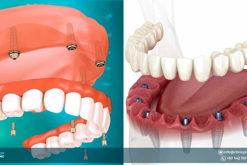 All on 6 Dental Implants Abroad vs All-on-4 in Turkey: Which Is Right for You? 2026