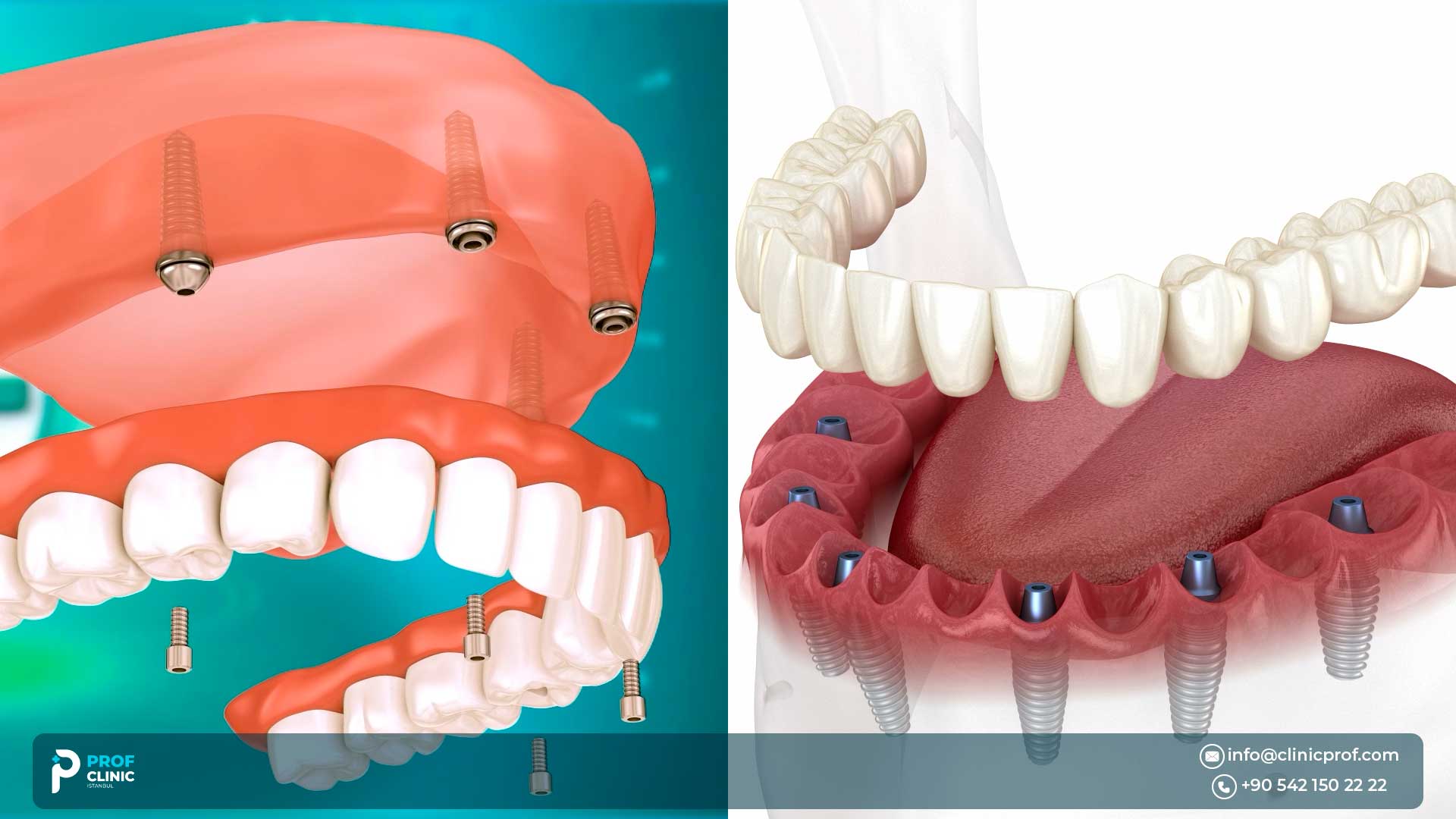 All on 6 Dental Implants Abroad vs All-on-4 in Turkey: Which Is Right for You? 2026