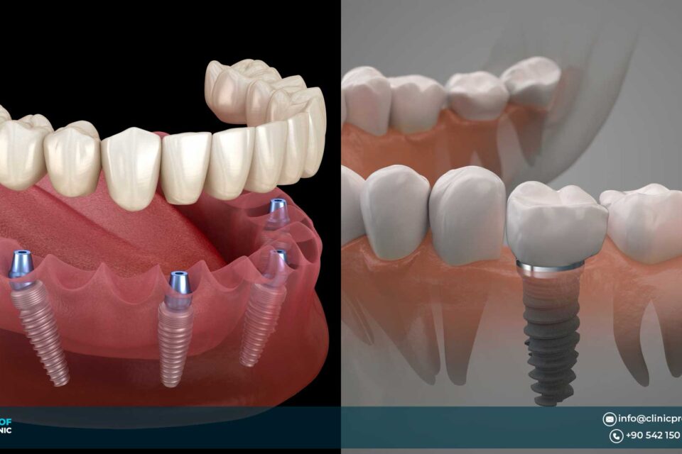 all on 4 dental implants abroad