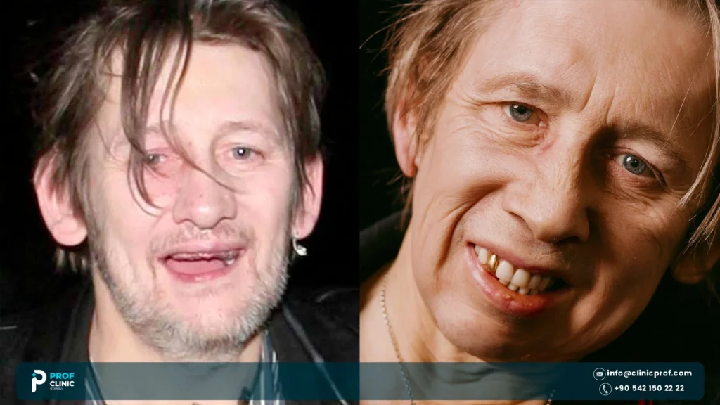Shane MacGowan Teeth: Before and After the Restoration 1 Shane Macgowan teeth before and after