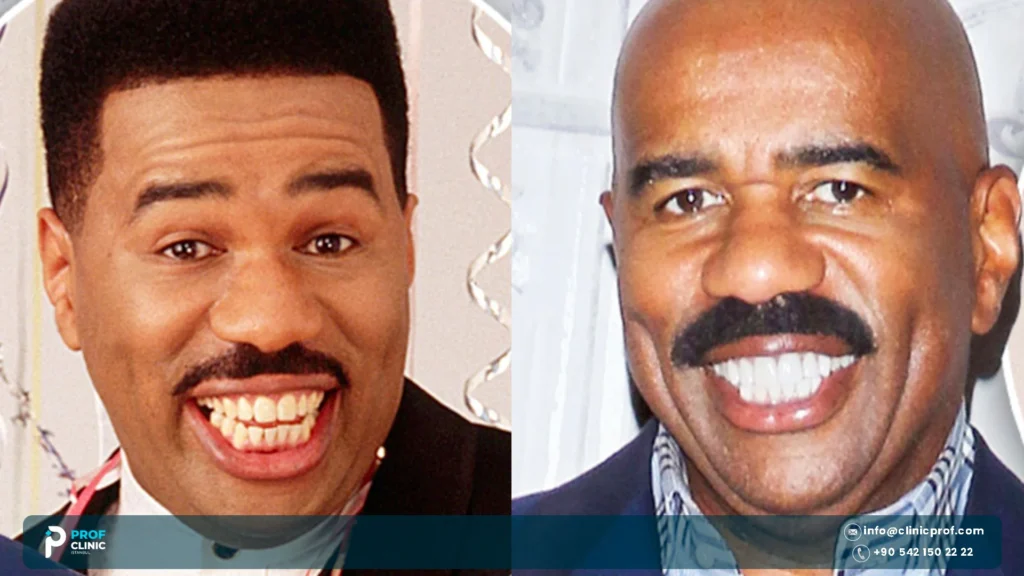 Does Steve Harvey have veneers?