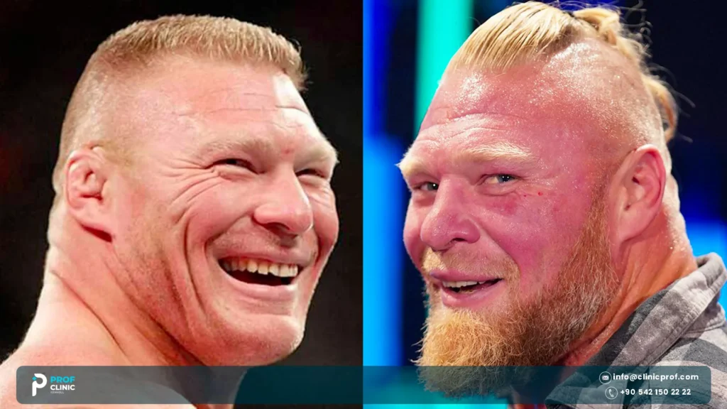 Brock Lesnar Teeth before and after