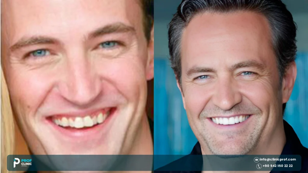 matthew perry teeth before and after