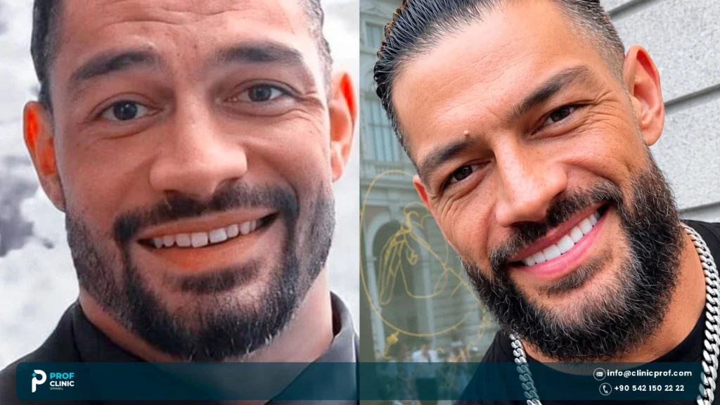 Roman Reigns Teeth: Ring Damage, Repairs and Smile Today 1 Roman Reigns teeth before and after