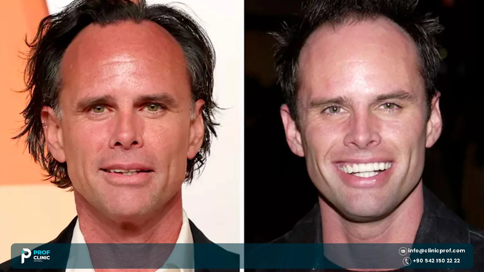 walton goggins teeth before and after