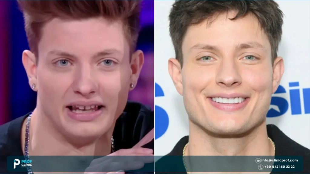 Matt Rife teeth before and after