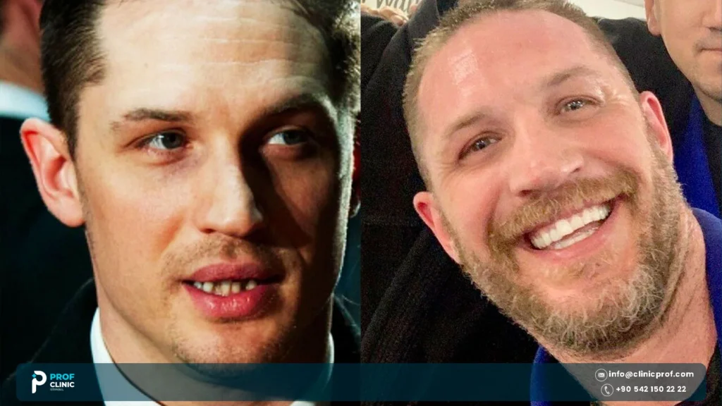 Tom Hardy Teeth Before and After