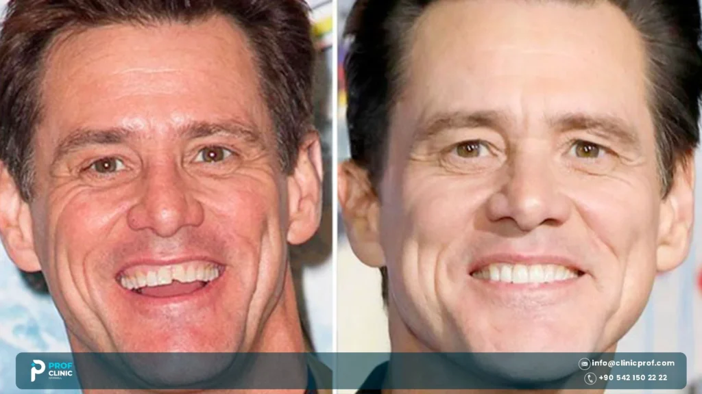 Jim Carrey teeth before and after