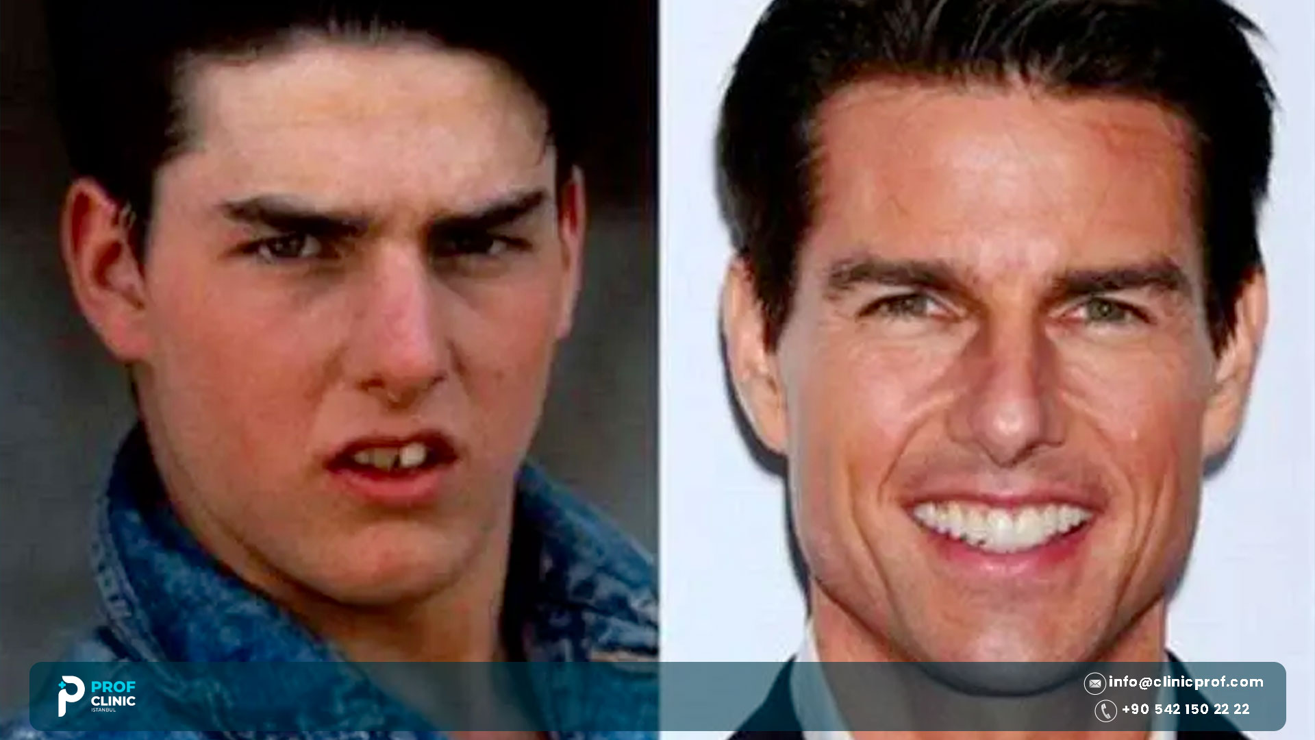 Tom Cruise Teeth: The Middle Tooth Story, Before and After 2 Tom Cruise Teeth: The Middle Tooth Story, Before and After