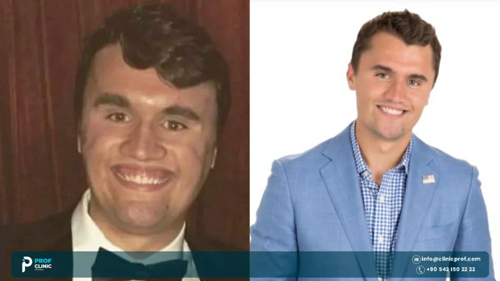 Charlie Kirk teeth before and after