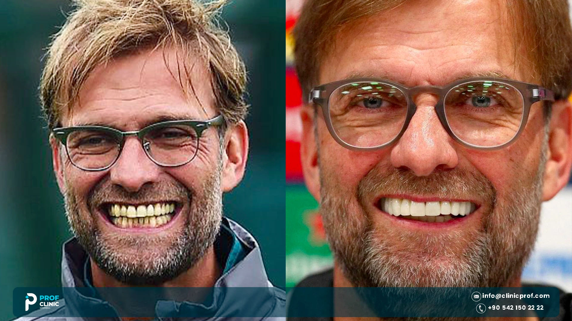 How Jurgen Klopp's Veneers Changed His Whole Smile 1 How Jurgen Klopp's Veneers Changed His Whole Smile 1000020728 1