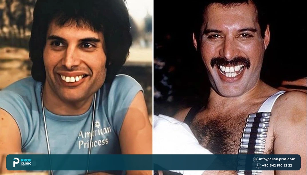 Freddie Mercury teeth condition