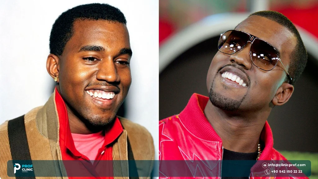 Kanye West Teeth: Titanium Grill, Implants or Prosthetics? 1000021355
