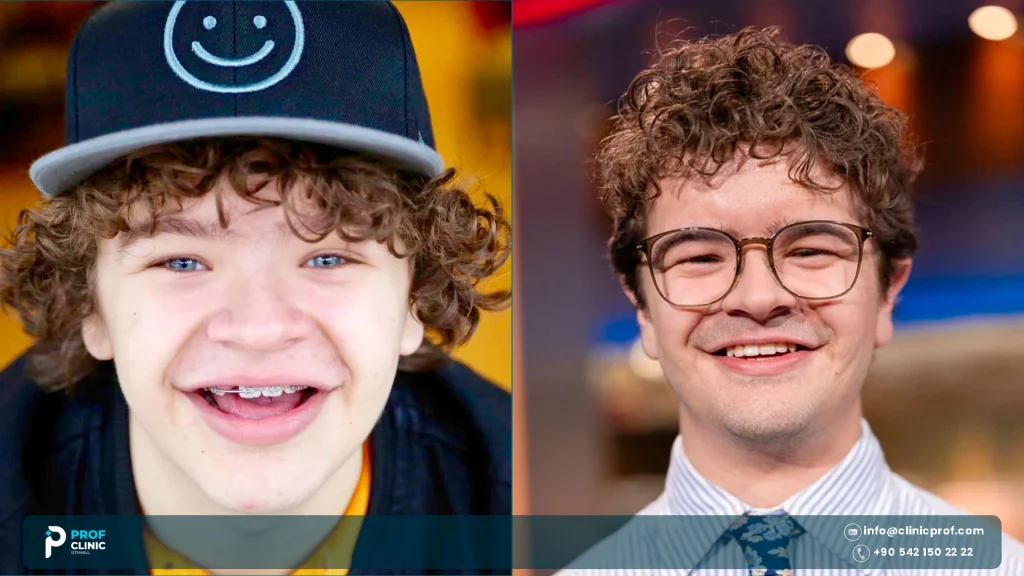 Gaten Matarazzo teeth now and then 