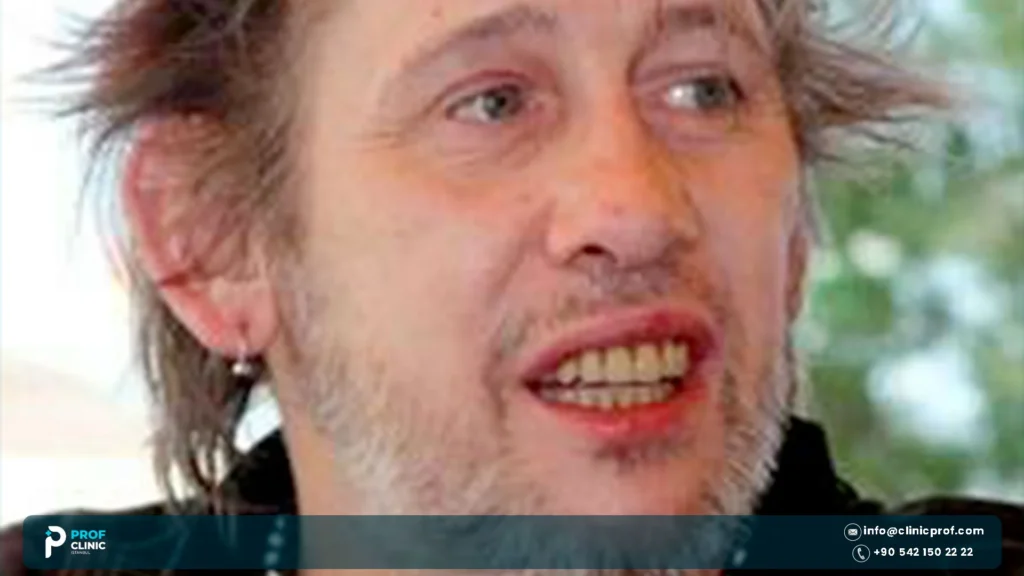 Shane MacGowan Teeth: Before and After the Restoration 2 Shane MacGowan Teeth: Before and After the Restoration