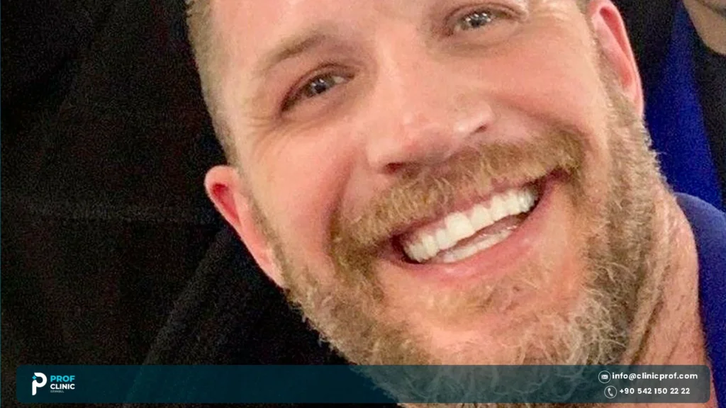 Fixed veneers Tom Hardy teeth