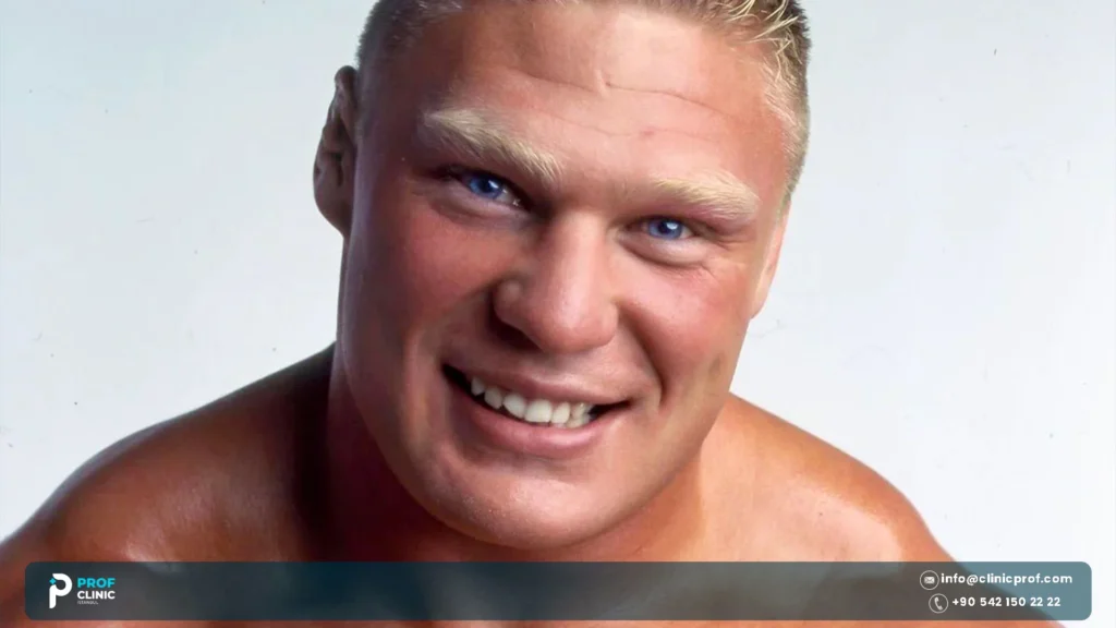 Brock Lesnar teeth explained