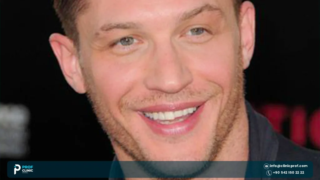 Tom Hardy Teeth: Before, After and What Really Changed