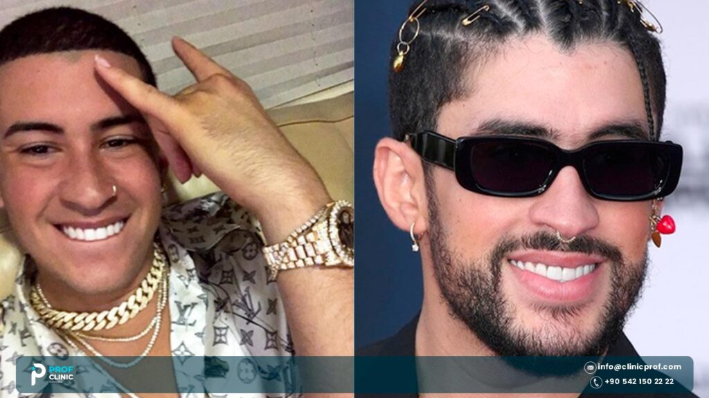 Bad Bunny teeth before and after