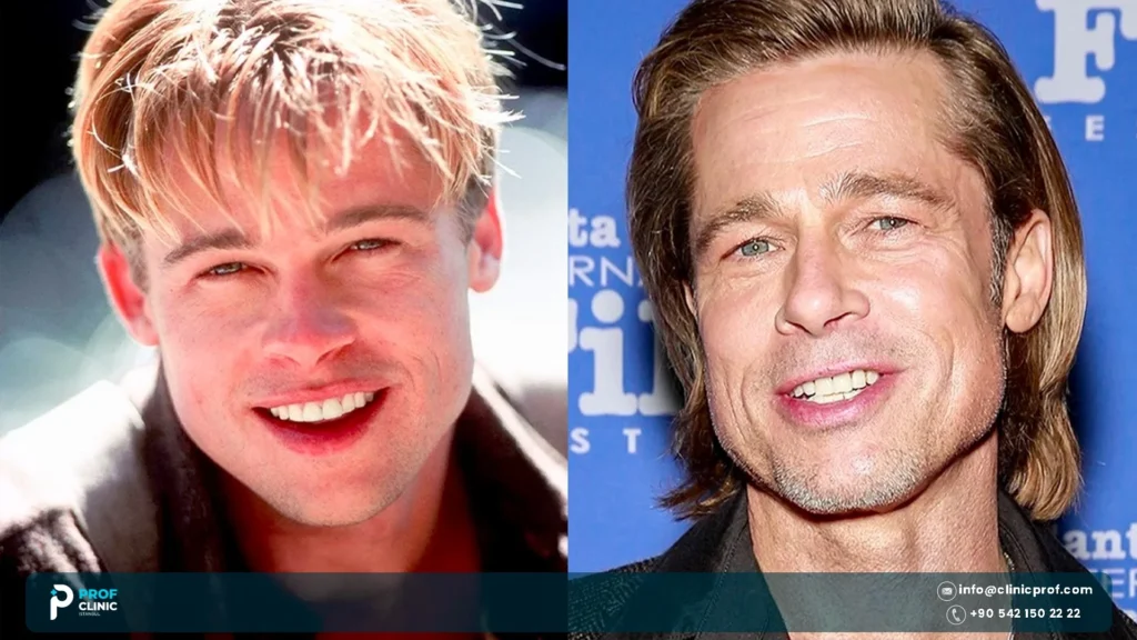 Brad Pitt teeth before and after