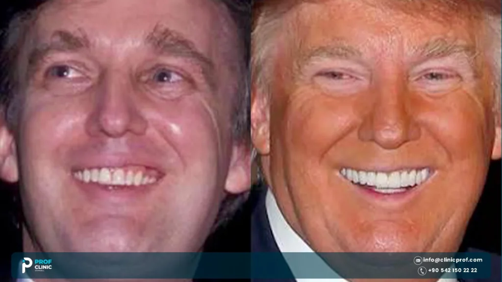 Donald Trump's Teeth: Dentures, Crowns or Real? 3 Donald Trump's Teeth before and after
