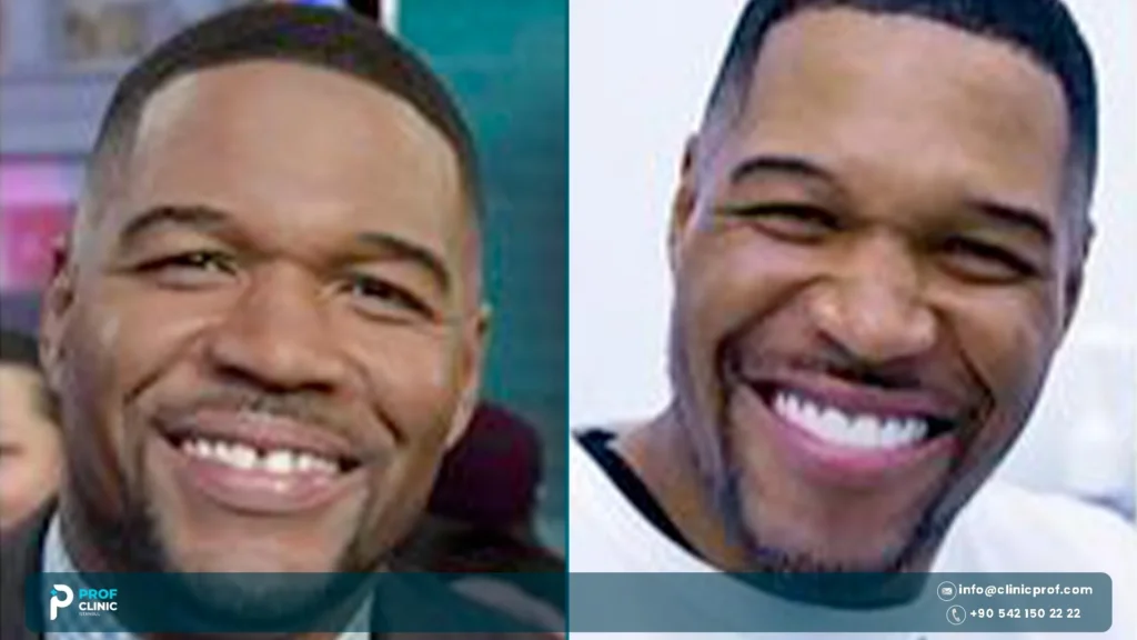 Michael Strahan Teeth: Did He Ever Close His Gap? 2 Michael Strahan teeth gap explained