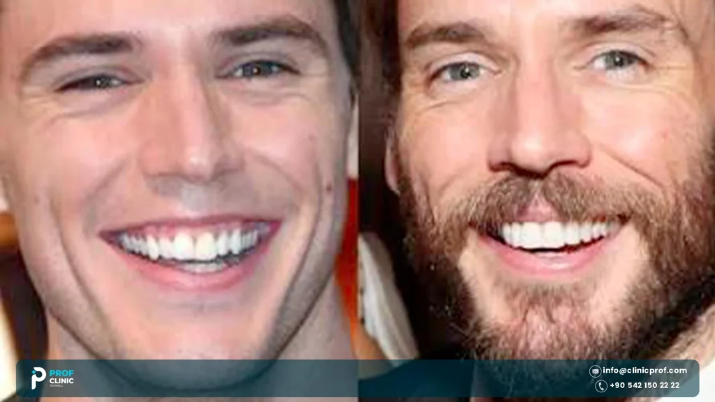 Sam Claflin Teeth: What Changed Between Roles? 1 Sam Claflin Teeth before and after