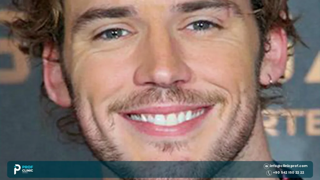 Sam Claflin Teeth: What Changed Between Roles? 3 What Changed About Sam Claflin Teeth Between Roles