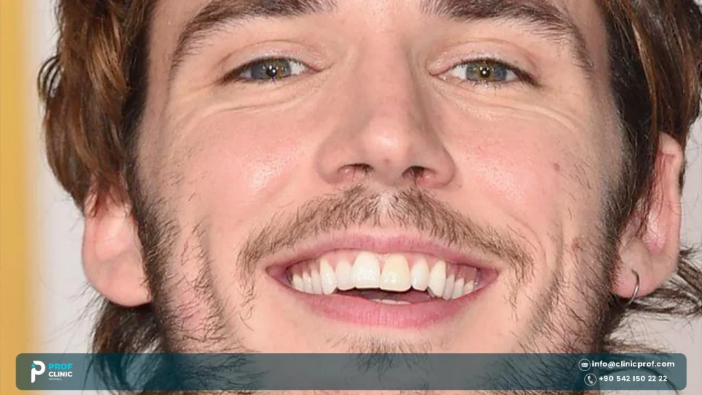 Sam Claflin Teeth: What Changed Between Roles? 2 Sam Claflin teeth explained