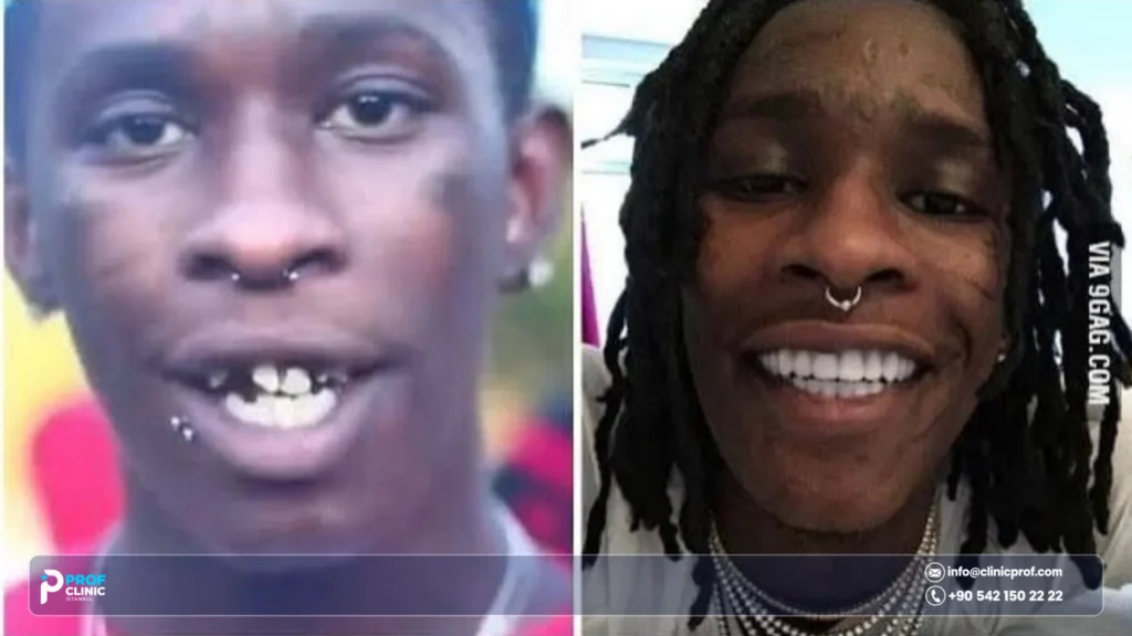 Young Thug's Teeth Before Fame and After: What Changed? 1 Young Thug teeth before fame