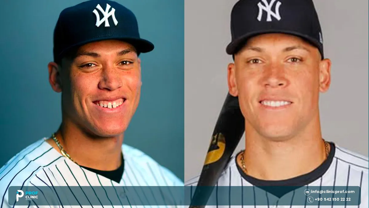 Aaron Judge teeth in a close-up photograph during a Yankees game