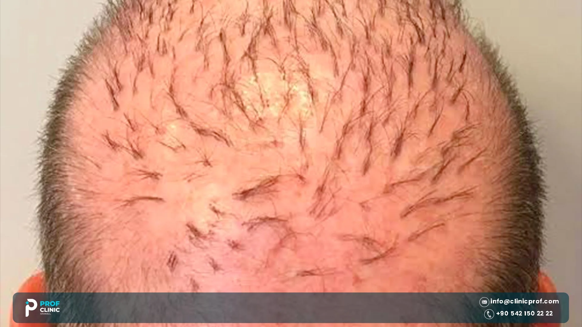 New hair starting to grow on the crown after a hair transplant