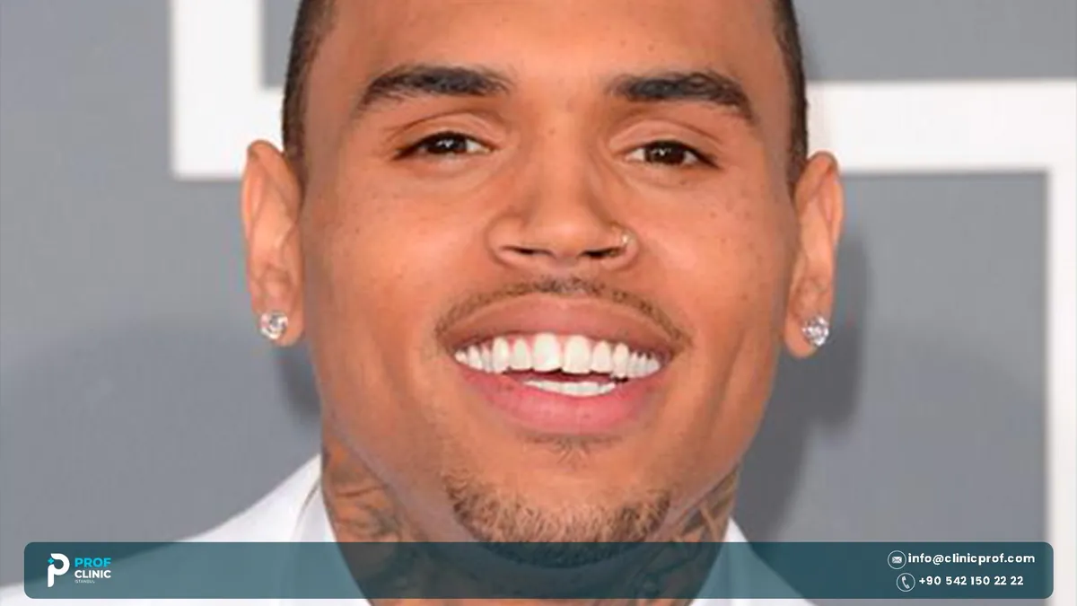 Close-up of Chris Brown smiling, showing his upper teeth for a Chris Brown teeth article