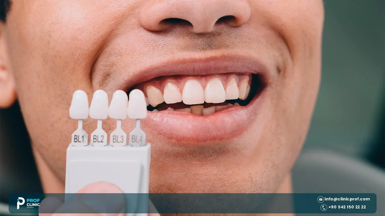 Shade guide samples held beside a man's smile