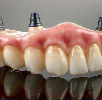 All-on-4 and All-on-6 full-arch dental implants