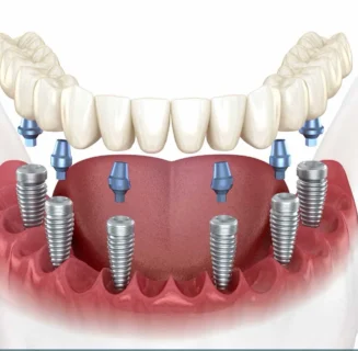 All-on-4 and All-on-6 full-arch dental implants