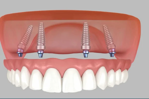 All-on-4 and All-on-6 full-arch dental implants
