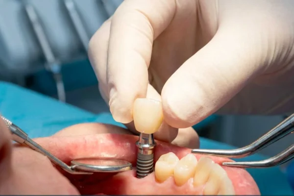 Zirconia and E-max dental crowns and bridges